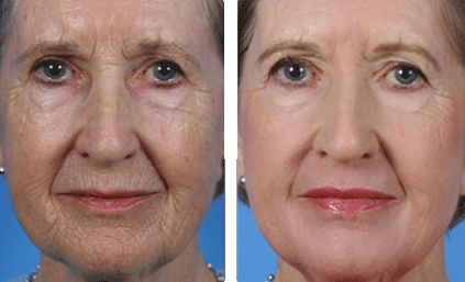 Laser Skin Resurfacing Naperville, Aurora, Lisle - Before & After