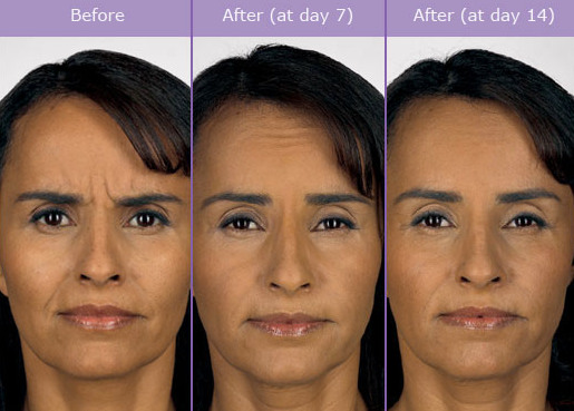 Botox Treatment Naperville, Aurora, Lisle - Before & After