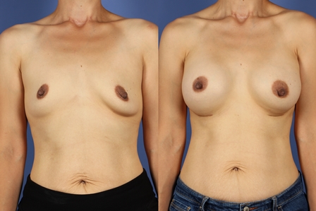 Breast Augmentation with Silicone Implants