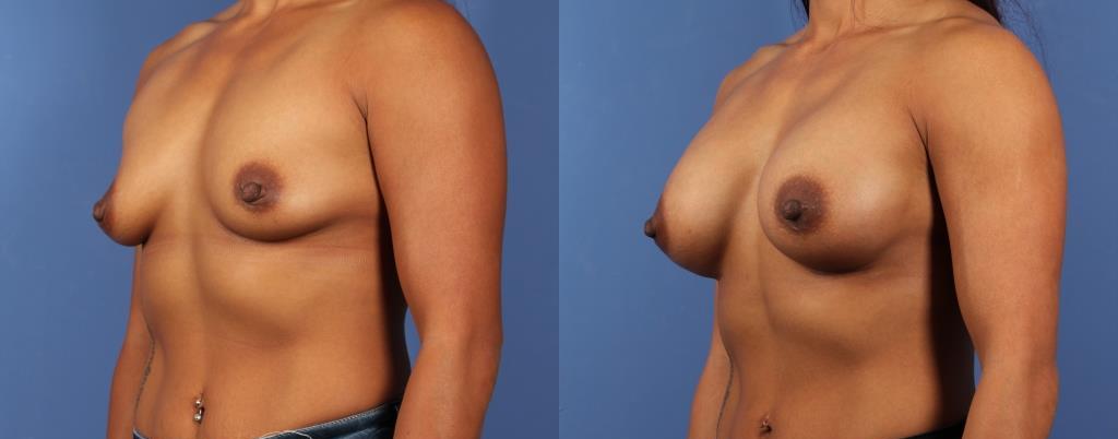 Breast Augmentation with Silicone Implants