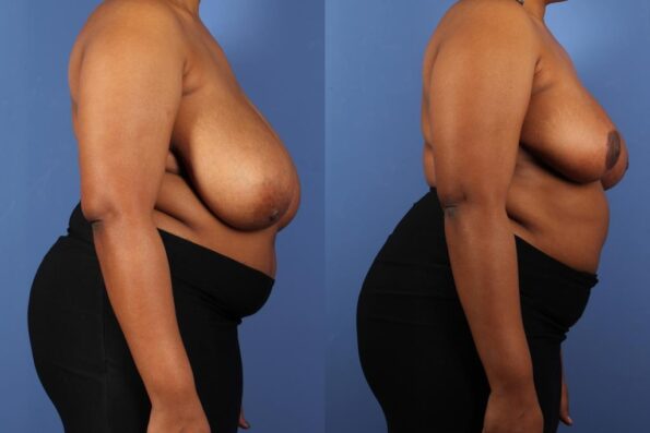 Patient Benefits from The Stevens Laser Bra Breast Lift or Breast Reduction  Surgery