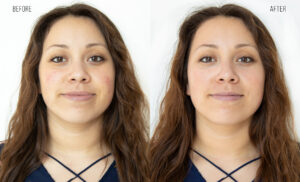 HydroFacial Customized Treatment Before and After