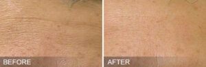 Fine Lines Before & After