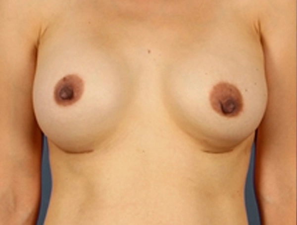 Breast Augmentation Before and After