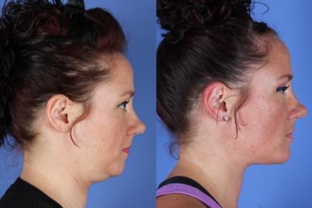 Neck lift Before & After photo of a female patient at CCLS.